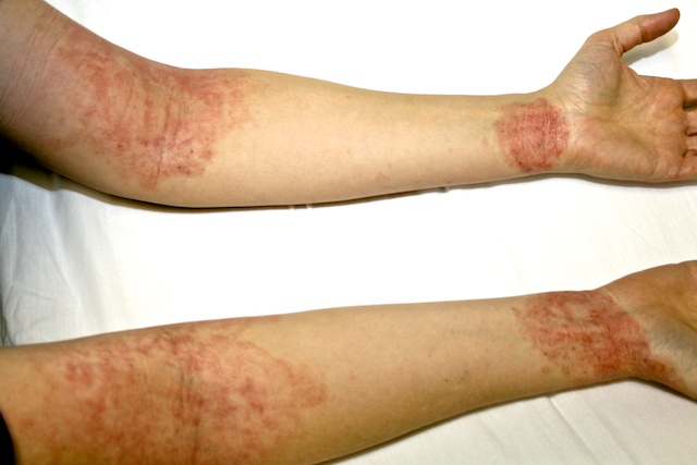 Eczema Arms Photos - Dermatology Education
