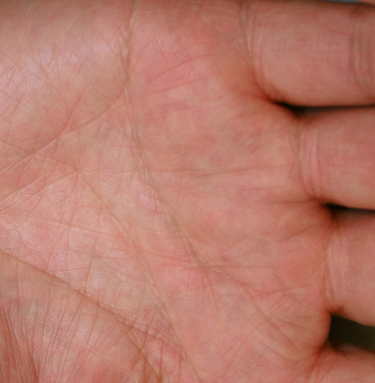 Eczema Take Care Of Those Hands Dr Trevor Erikson