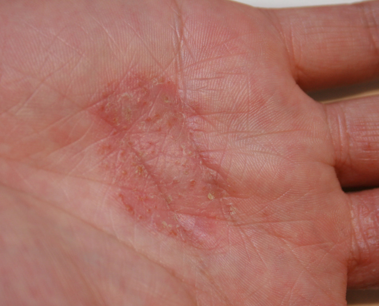eczema on hands treatment