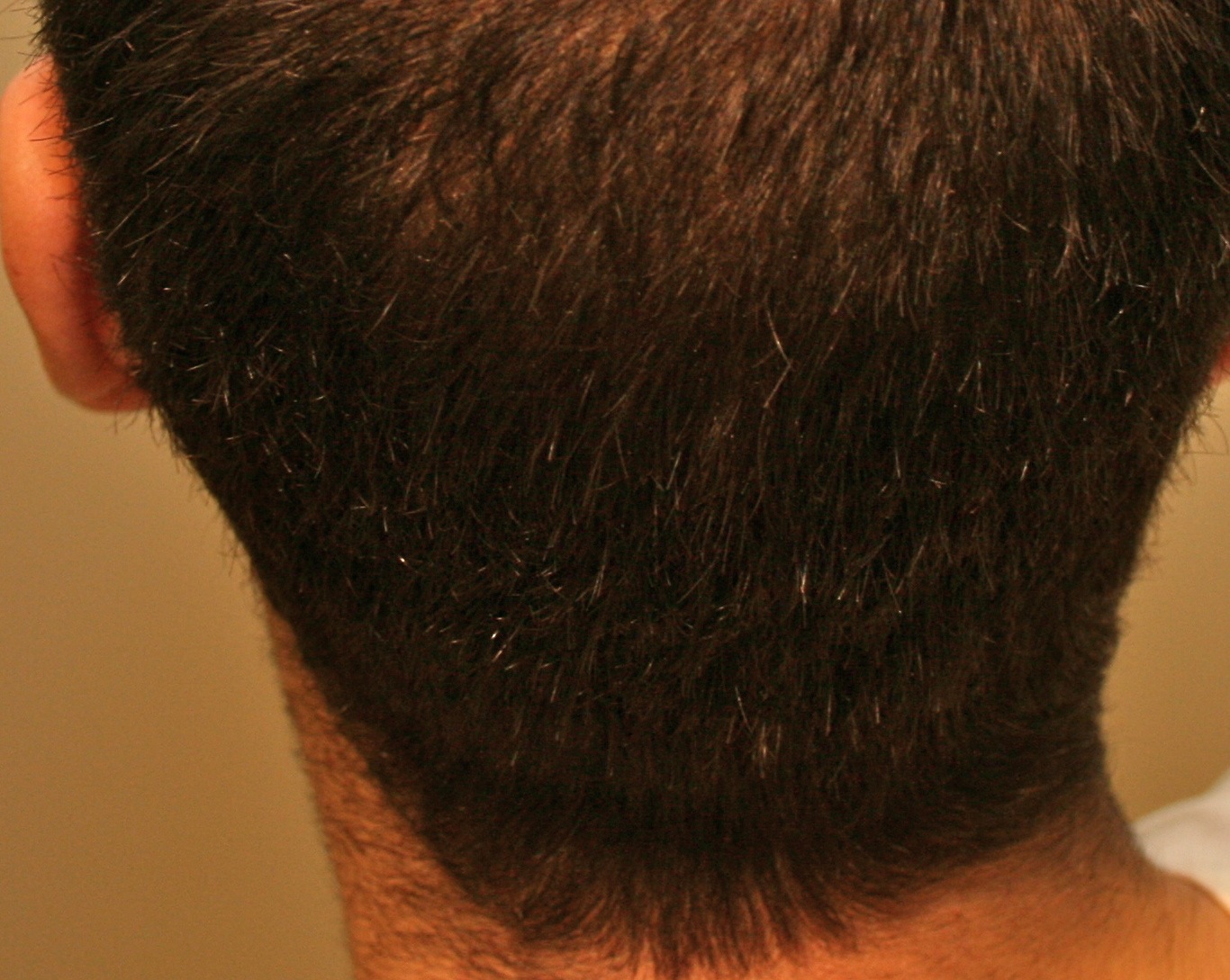 Alopecia Hair Loss on If You Would Like Dr  Erikson To Personally Treat Your Hair Loss  Or