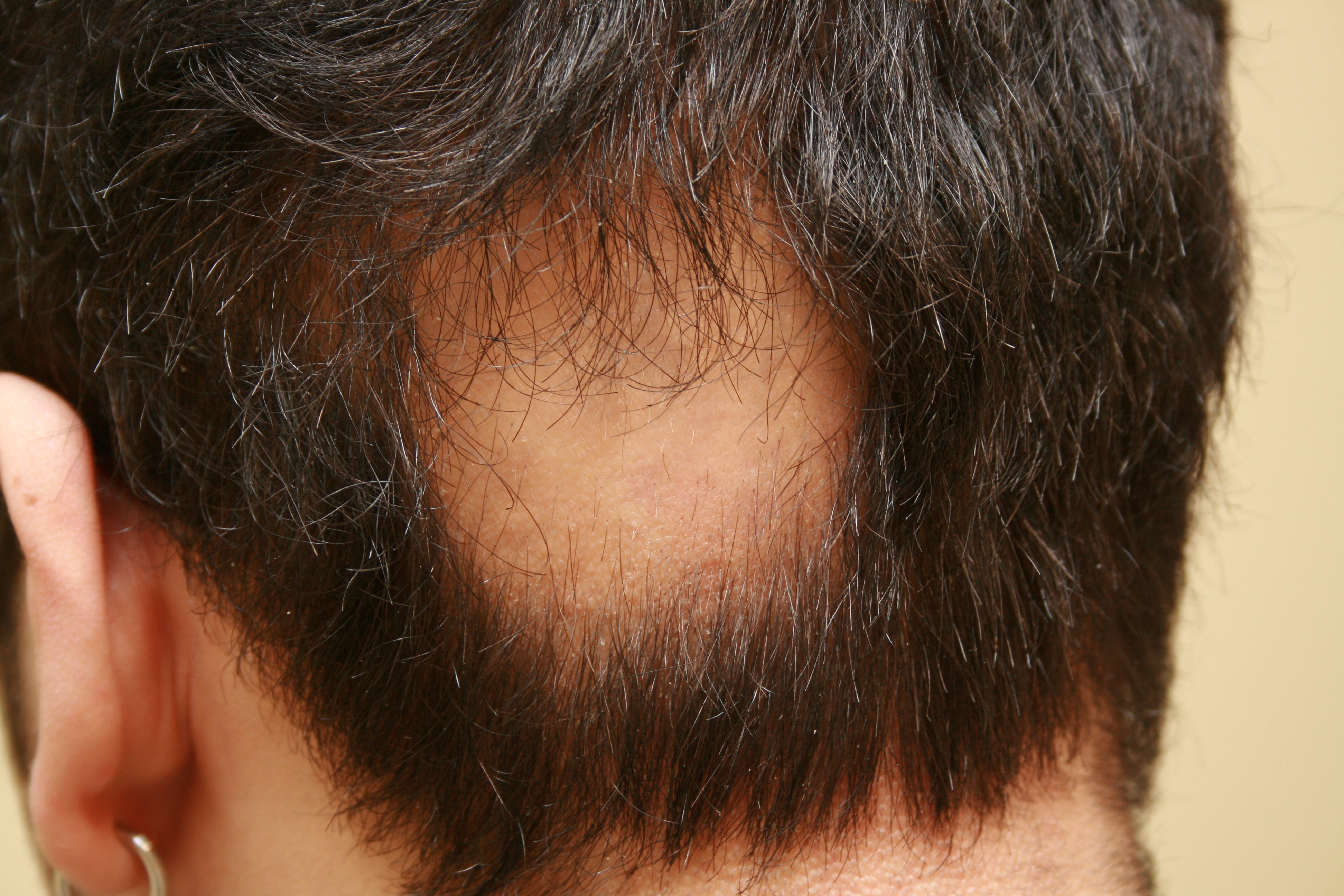 http://drerikson.files.wordpress.com/2011/10/alopecia-areata-before.jpg