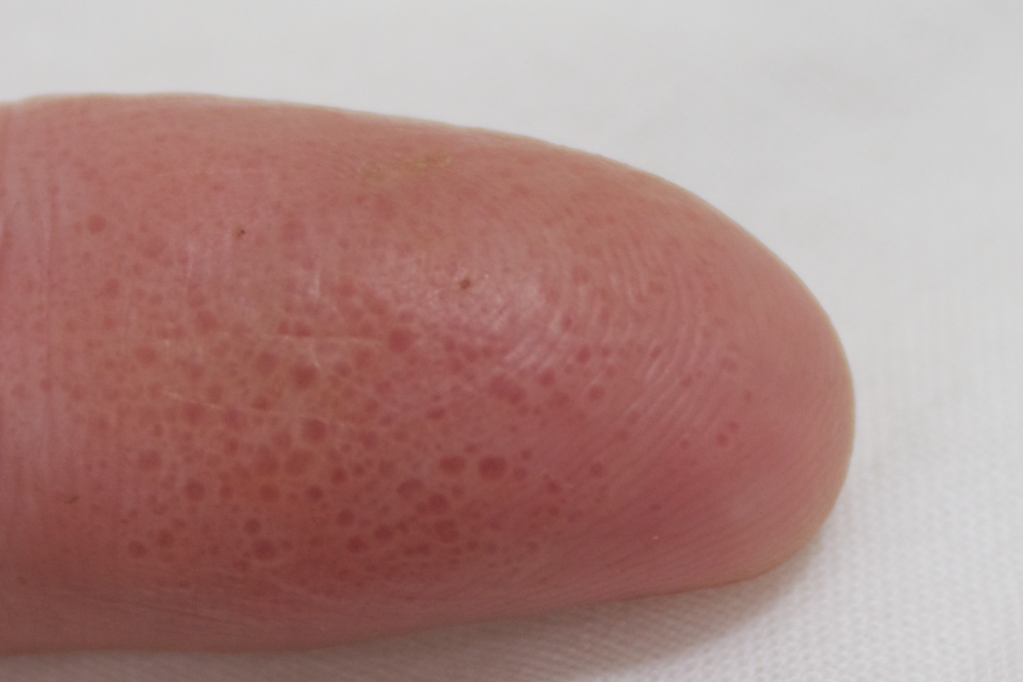 Eczema On Fingertips