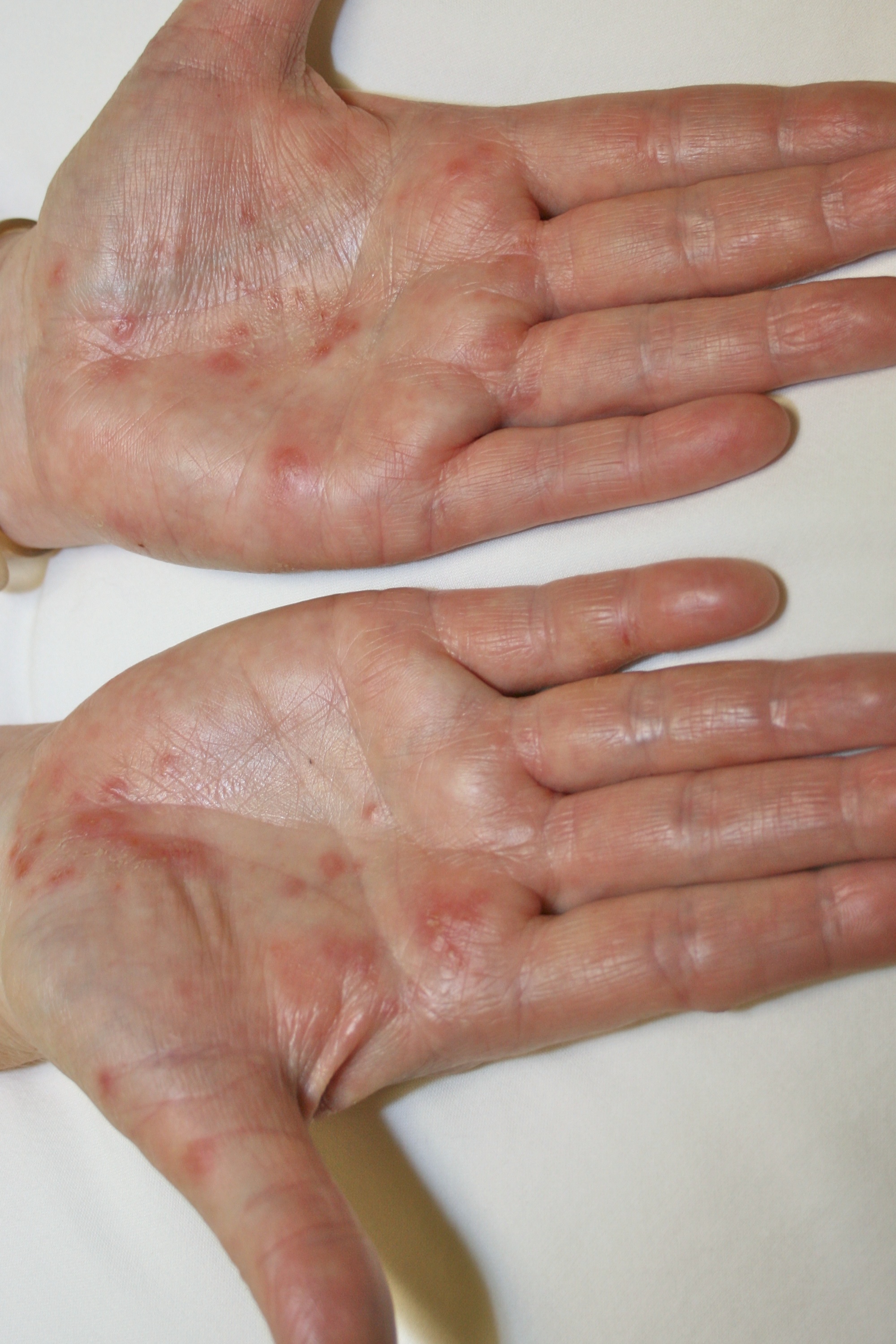 Can you get shingles on the palms of your hands? And does ...
