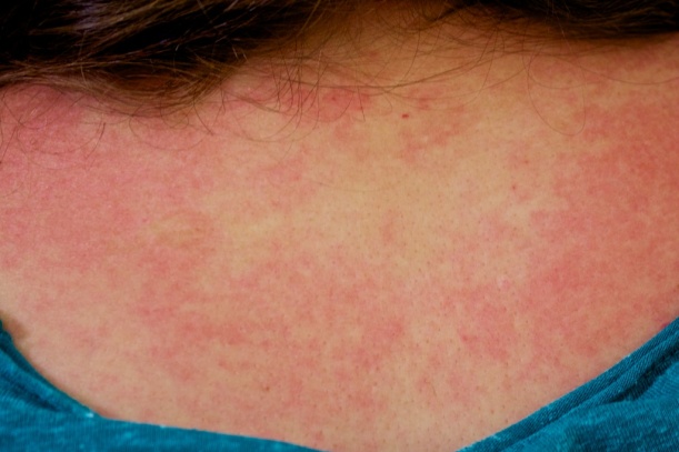 Eczema of the back